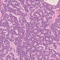 カルチノイド腫瘍